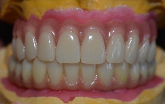 Elevando padrões nosso controle de qualidade da coroa do implante dental