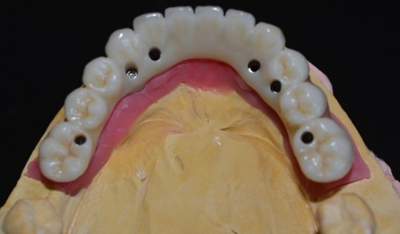 Elevando padrões nosso controle de qualidade da coroa do implante dental