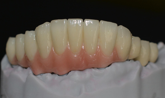 Abraçando avanços tecnologicos o futuro de coroas do implante dental