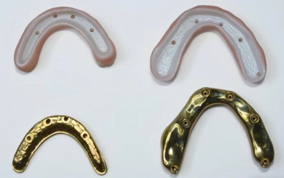 Ponte de zircônio completo com suporte de barra de titânio, coroas de zircônio com pontes com suporte de barra de titânio durável