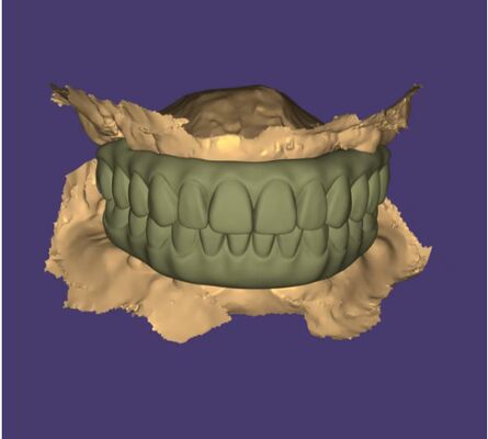 Projete o serviço profissional de design de ponte de implante de arco completo AOX