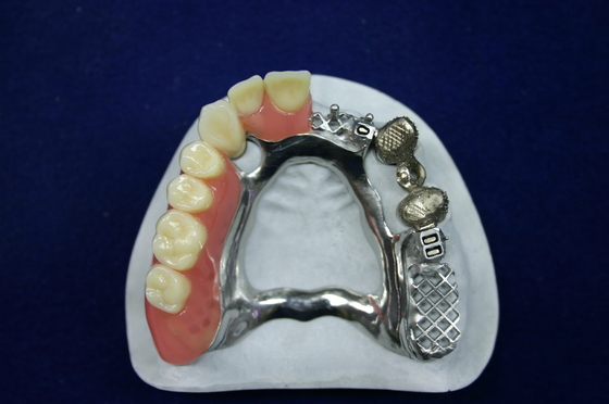 Bela aparência Apego de precisão Prótese dentária Apegos de implantes