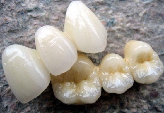 Porcelana alta da coroa de Biocompatibility PFM fundida para a restauração dos dentes traseiros