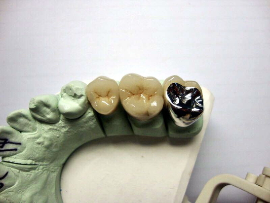 Porcelana alta da coroa de Biocompatibility PFM fundida para a restauração dos dentes traseiros