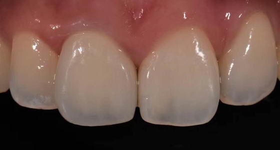 Porcelana alta da coroa de Biocompatibility PFM fundida para a restauração dos dentes traseiros