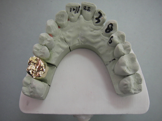 Elevação dental completa da ponte da coroa do metal PFM - material biológico da tecnologia