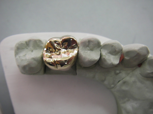 Elevação dental completa da ponte da coroa do metal PFM - material biológico da tecnologia