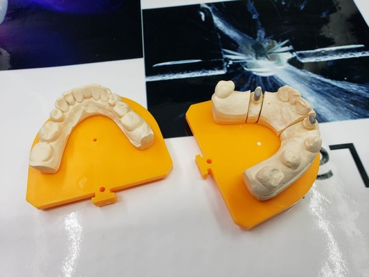 Elevação dental completa da ponte da coroa do metal PFM - material biológico da tecnologia