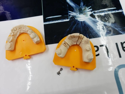 Elevação dental completa da ponte da coroa do metal PFM - material biológico da tecnologia