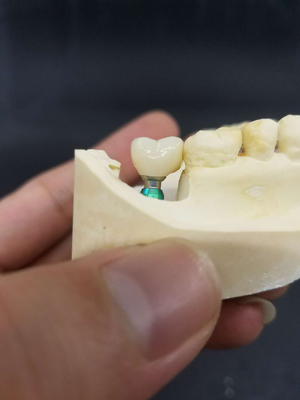 A coroa Biocompatible de superfície lisa do dente da zircônia fácil mantém