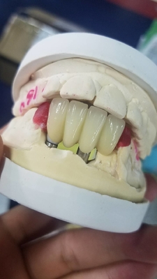 A coroa Biocompatible de superfície lisa do dente da zircônia fácil mantém