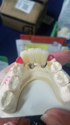 A coroa Biocompatible de superfície lisa do dente da zircônia fácil mantém