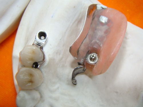 A dentadura duradouro do acessório da precisão do laboratório dental mancha resistente