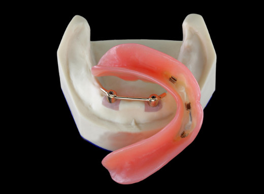 Implante dental da segurança do laboratório da dentadura inter biológica alta da miscibilidade
