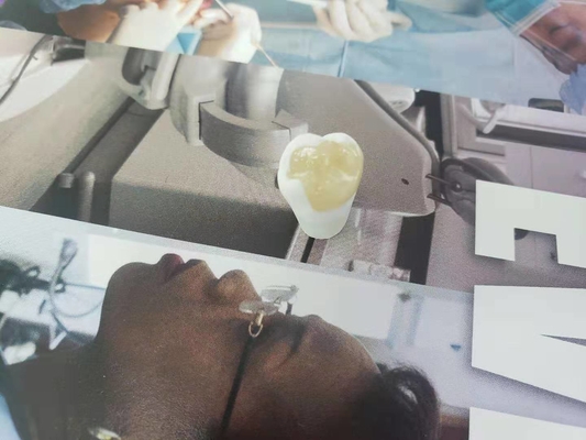 Onlay dental Todo-cerâmico durável do embutimento do folheado da coroa de FDA similar