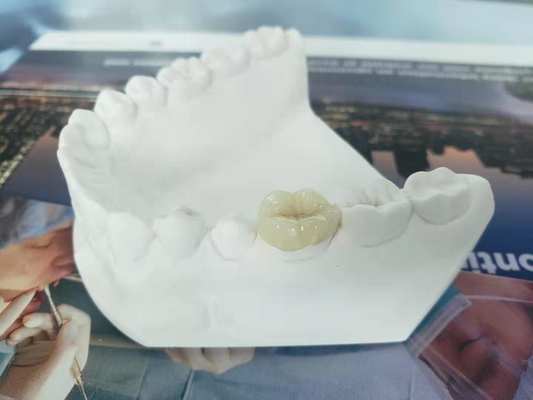 Onlay dental Todo-cerâmico durável do embutimento do folheado da coroa de FDA similar