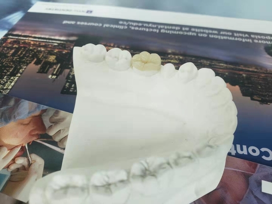 Onlay dental Todo-cerâmico durável do embutimento do folheado da coroa de FDA similar