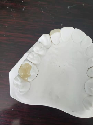 Onlay dental Todo-cerâmico durável do embutimento do folheado da coroa de FDA similar