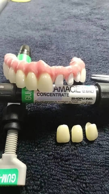 CAD-CAM Resina-baseado fixou a restauração removível da estética da ponte
