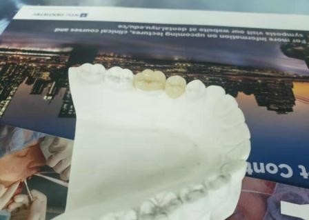 Coroa flexível durável IPS dental E Max Press Inlay Onlay da ponte de PFM