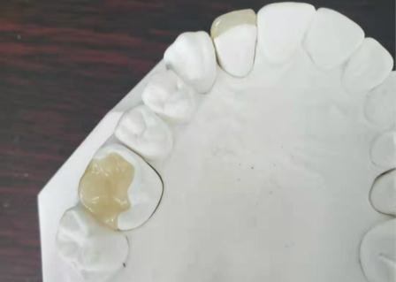 Coroa flexível durável IPS dental E Max Press Inlay Onlay da ponte de PFM