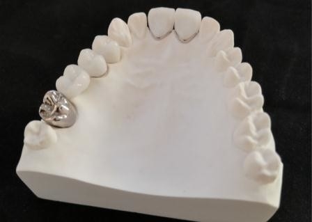 Resistência de corrosão completa personalizada do metal da coroa dental da porcelana de PFM