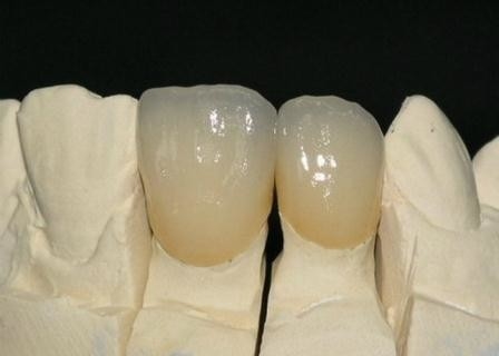 Coroa Metal-cerâmica de superfície lisa de PFM resistente à corrosão