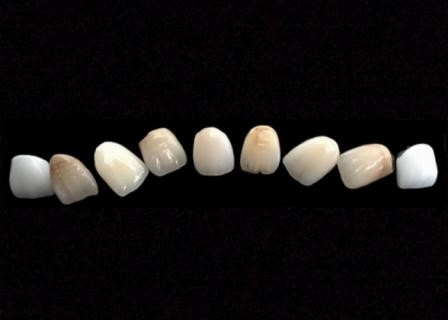 Coroa Metal-cerâmica de superfície lisa de PFM resistente à corrosão