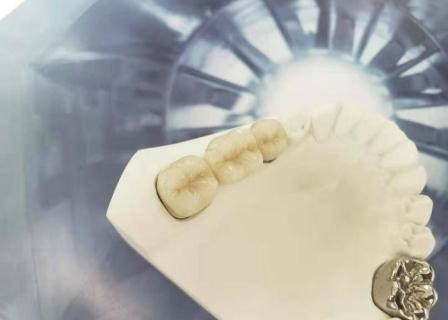 Coroa dental de lustro Intermiscibility biológico alto da porcelana do OEM