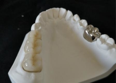 Coroa dental de lustro Intermiscibility biológico alto da porcelana do OEM
