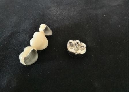 Coroa dental de lustro Intermiscibility biológico alto da porcelana do OEM