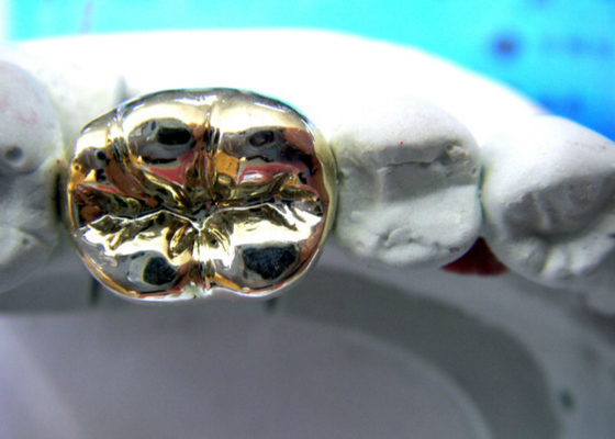 Carcaça fácil dental semi preciosa alta da ponte PFM da coroa da estabilidade