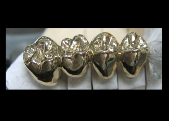 Carcaça fácil dental semi preciosa alta da ponte PFM da coroa da estabilidade