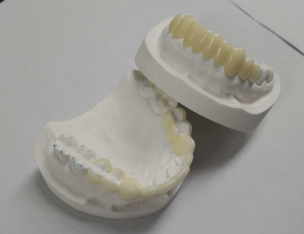 Alta durabilidade CAD CAM Impressão 3D Coroas temporárias Resina durável