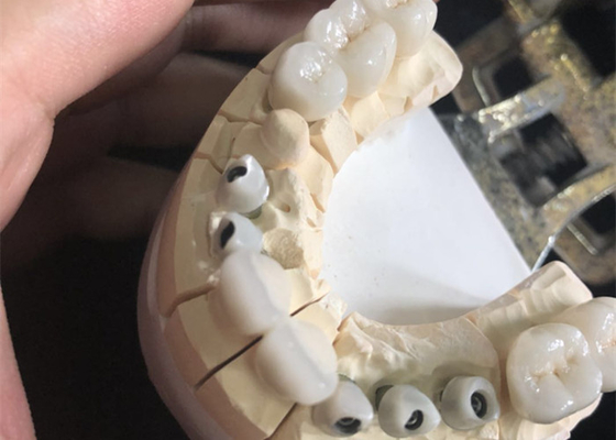 Coroas dentais Biocompatibility excelente da zircônia branca livre do metal