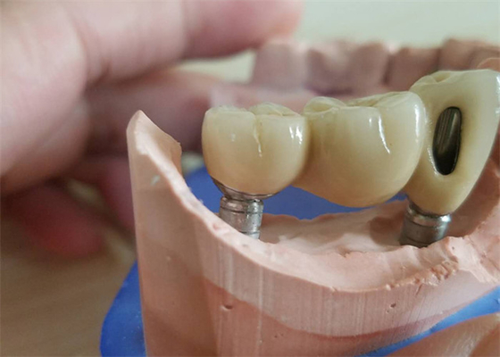 Coroa dental da zircônia do CAD CAM com o limite da zircônia da base do titânio