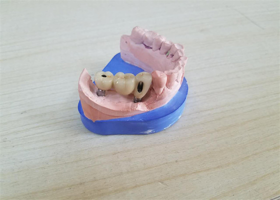 Coroa dental da zircônia do CAD CAM com o limite da zircônia da base do titânio