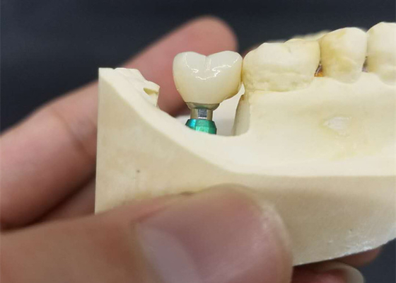 Colora ultra duramente o OEM que da estabilidade a coroa do implante dental fácil mantém