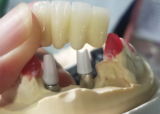 O si forte baseia o implante dental de trituração coroa a ponte apoiada dente