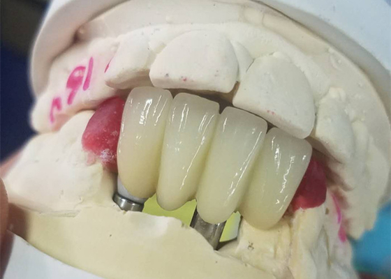 O si forte baseia o implante dental de trituração coroa a ponte apoiada dente