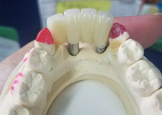 O si forte baseia o implante dental de trituração coroa a ponte apoiada dente