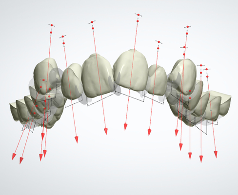 O retentor apoia FDA fixou o dispositivo ortodôntico com 3D