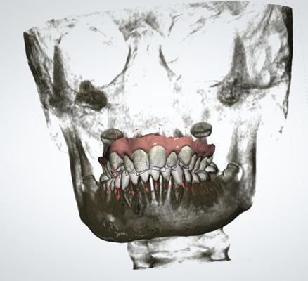 Expansor palatal rápido do OEM do dispositivo ortodôntico removível exato