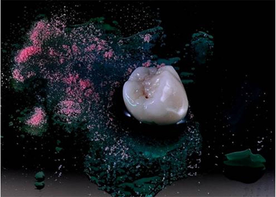 Folheie ultra duramente as dentaduras de lustro do implante da coroa Todo-cerâmica dentais