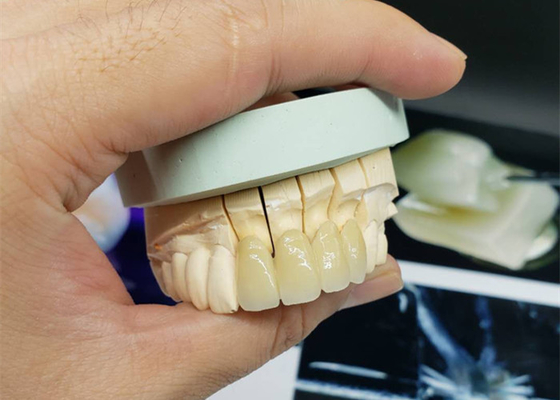 Coroa resistente à corrosão da porcelana do OEM da segurança todo o olhar natural cerâmico