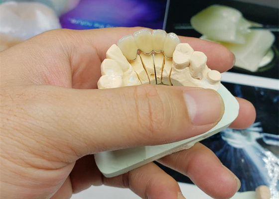 Coroa resistente à corrosão da porcelana do OEM da segurança todo o olhar natural cerâmico
