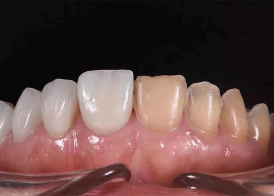 Coroa dental cerâmica clareando de 0.3MM para substituir os dentes insalubres