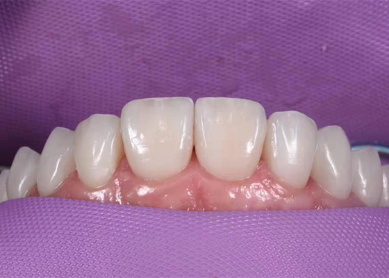 Coroa dental cerâmica clareando de 0.3MM para substituir os dentes insalubres