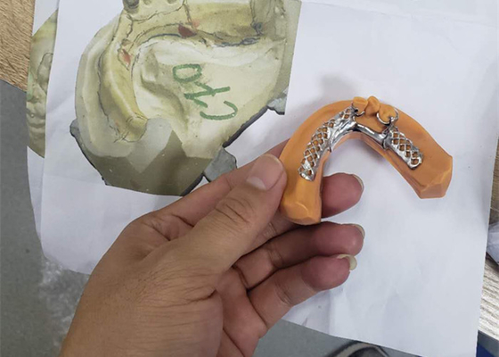 3D que imprime modelos dentais removíveis da estrutura da coroa para a odontologia