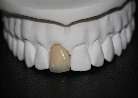 Coroa dental da porcelana do Cr do Co